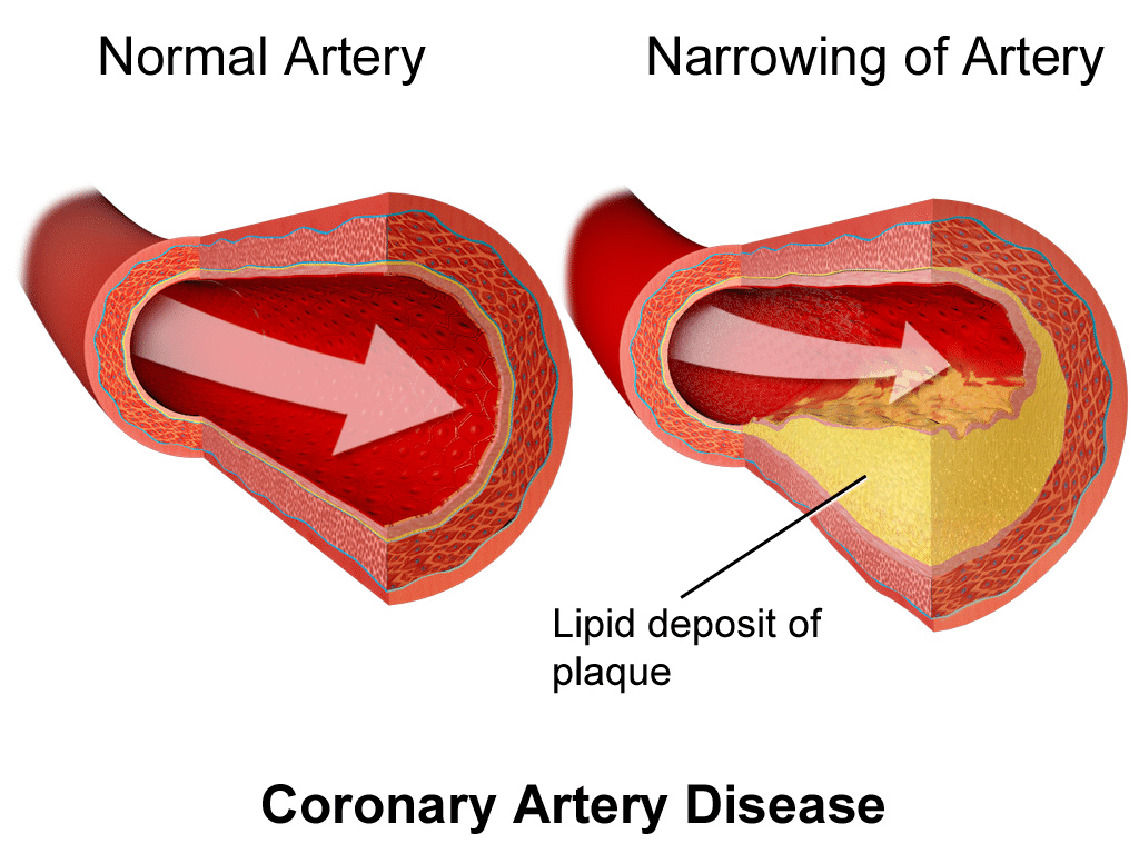 Acúmulo de lípidos en la placa de arterioesclerosis 