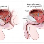 Hipertrofia de la prostata