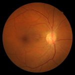 La retina se puede afectar por la presion alta