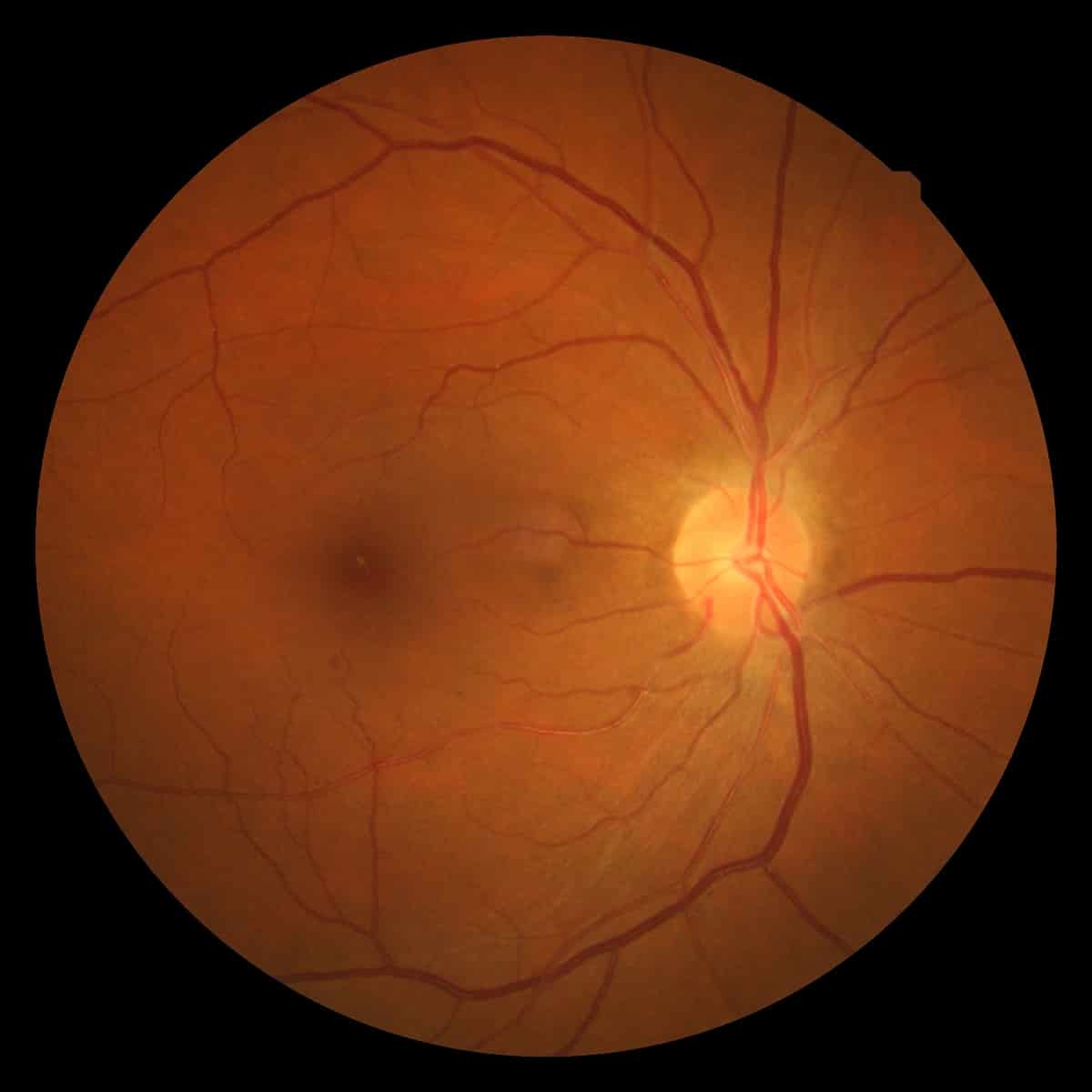 La presión arterial alta puede afectar la retina y llegar a producir ceguera