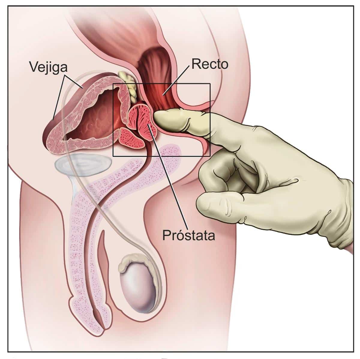 Diagnostico de aumento de tamaño de la próstata mediante el tacto rectal