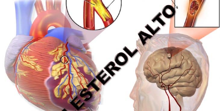 El cerebro y el corazón se pueden afectar por el colesterol alto