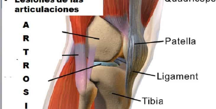 Las rodillas están entre las articulaciones más afectadas por artrosis.