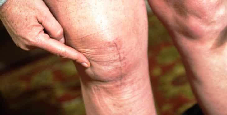 En ocasiones las artrosis requieren de un tratamiento quirúrgico