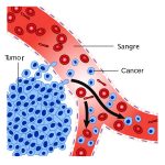 diagrama-que-muestra-como-se-diseminan-las-celulas-cancerosas-a-traves-de-la-sangre