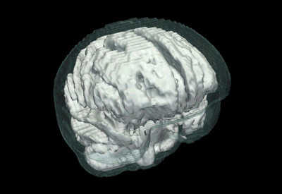 Alteraciones en el cerebro de una persona afectada de Parkinson