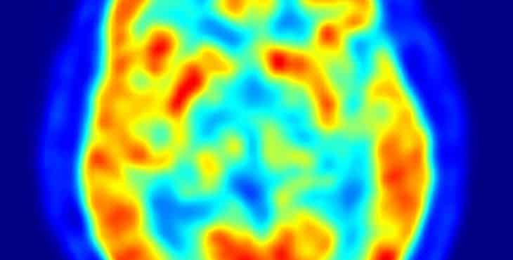 Imagen del cerebro por técnicas de PET para evaluar el daño en la enfermedad de Parkinson