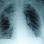 rayos-x-de-pulmones-evidenciando-las-manifestaciones-de-bronquitis