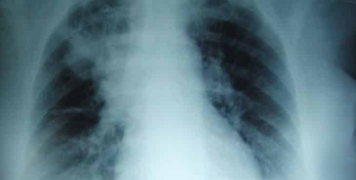 Imagenes radiologicas de los pulmones