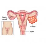 cancer de ovario