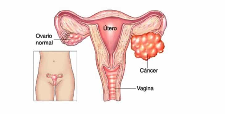 tipos de cáncer de ovarios