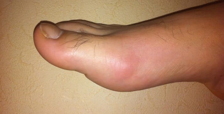 La gota se asocia a una inflamación y dolor muy agudo en el dedo gordo del pie