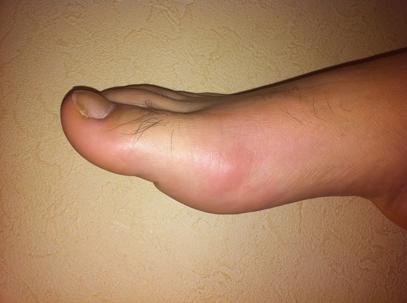 La gota se asocia a una inflamación y dolor muy agudo en el dedo gordo del pie