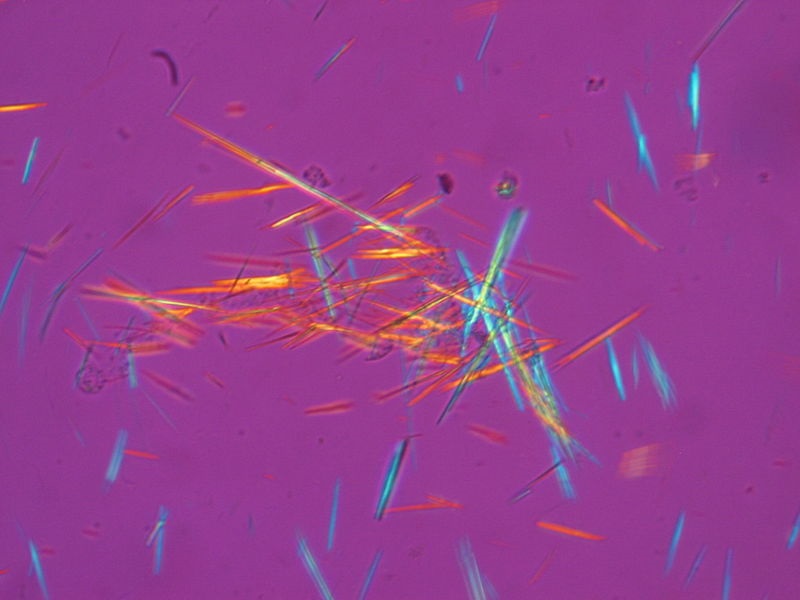La gota se produce como consecuencia del depósito de cristales de ácido úrico en las articulaciones