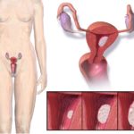 1-cancer de endometrio