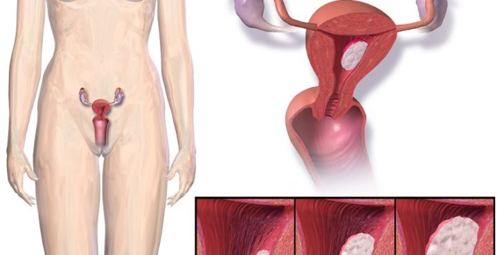 El sangramiento es el síntoma más común del cáncer de endometrio 