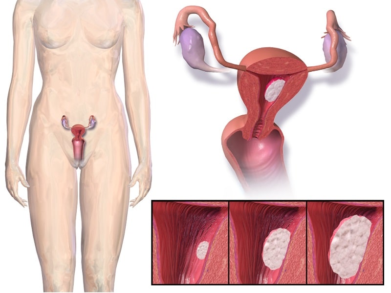 El sangramiento es el síntoma más común del cáncer de endometrio