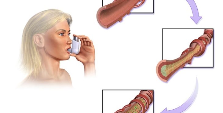 La respuesta a los broncodilatadores es una de las características del asma