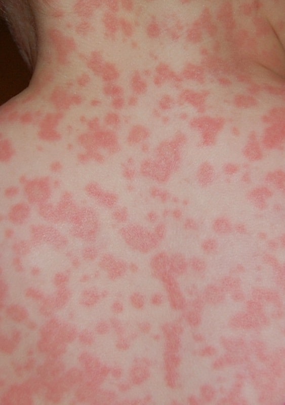 Las manifestaciones cutáneas son muy comunes en las reacciones alérgicas