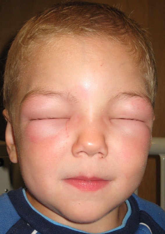 La anafilaxia es una complicación de la alergia alimentaria