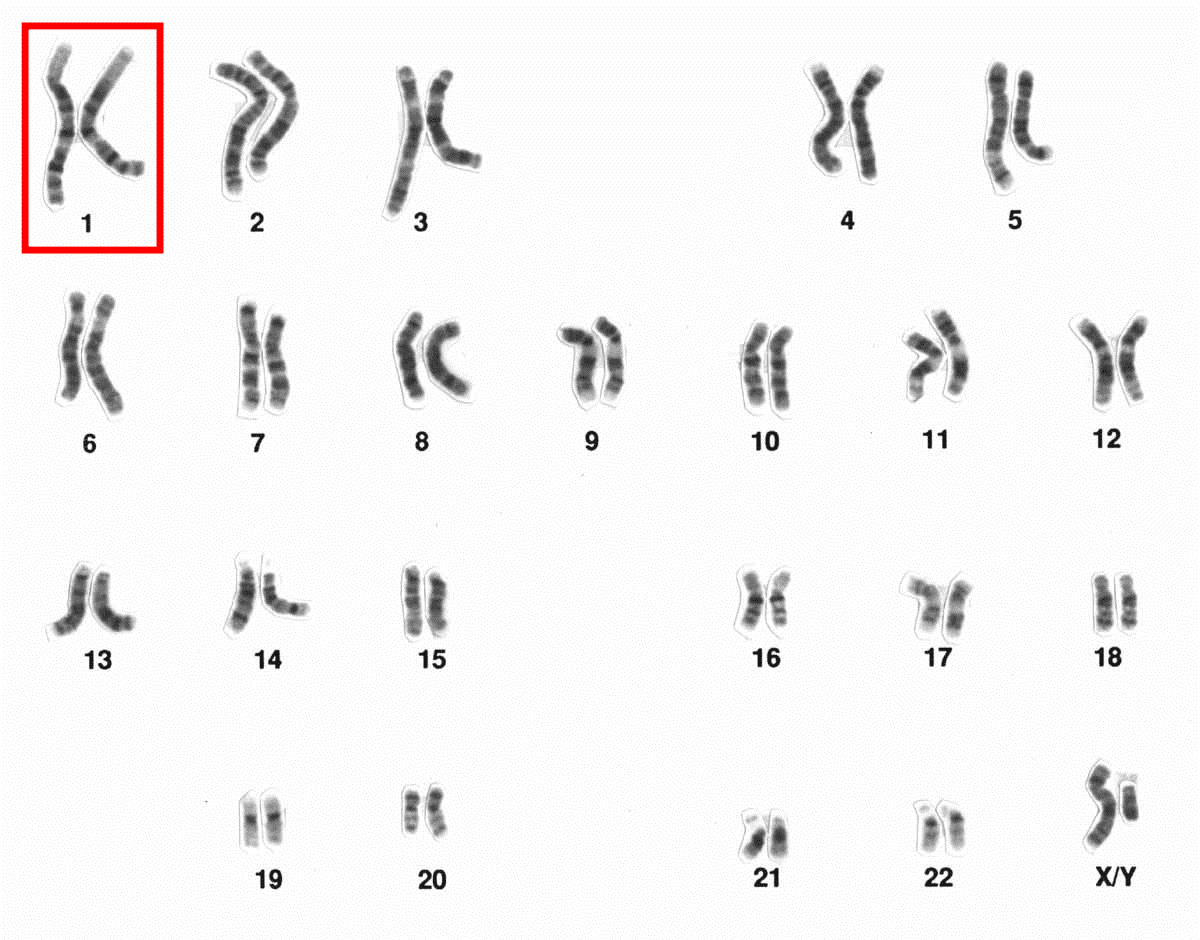 En el síndrome del olor a pescado aparece afectado el gen FMO3 en el cromosoma 1