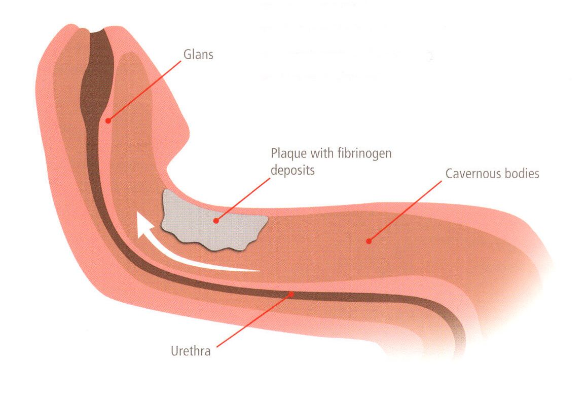 Cómo se produce el pene torcido