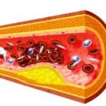 Placa de grasas en la pared de una arteria manifestcion de arterioesclerosis