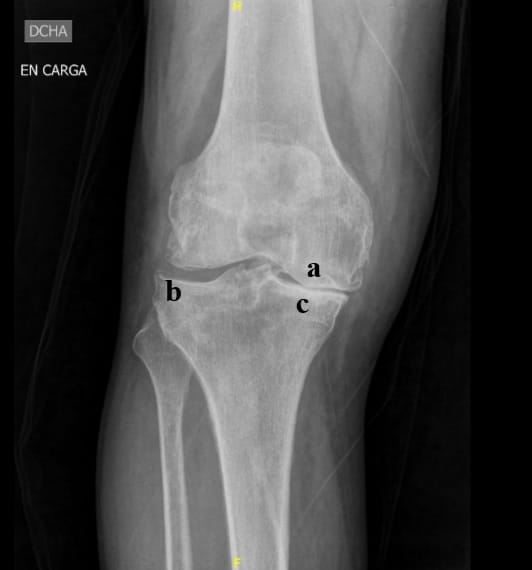 Radiografía de rodilla 
