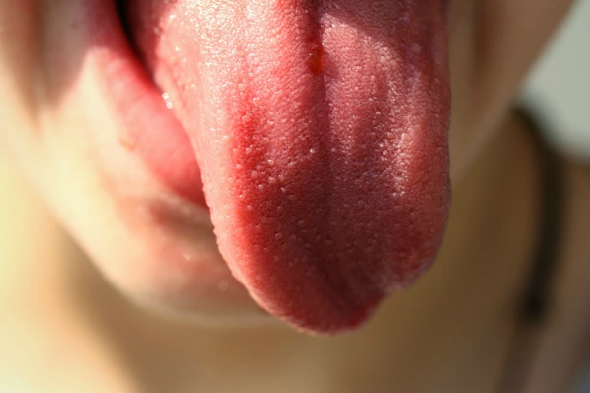 Primeros síntomas del cáncer de lengua, pueden ser confusos