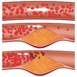 Placas de colesterol en la arteria