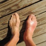 Diferencia entre pies hinchados y normales