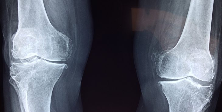 Estos son los síntomas del dolor de rodilla al correr.