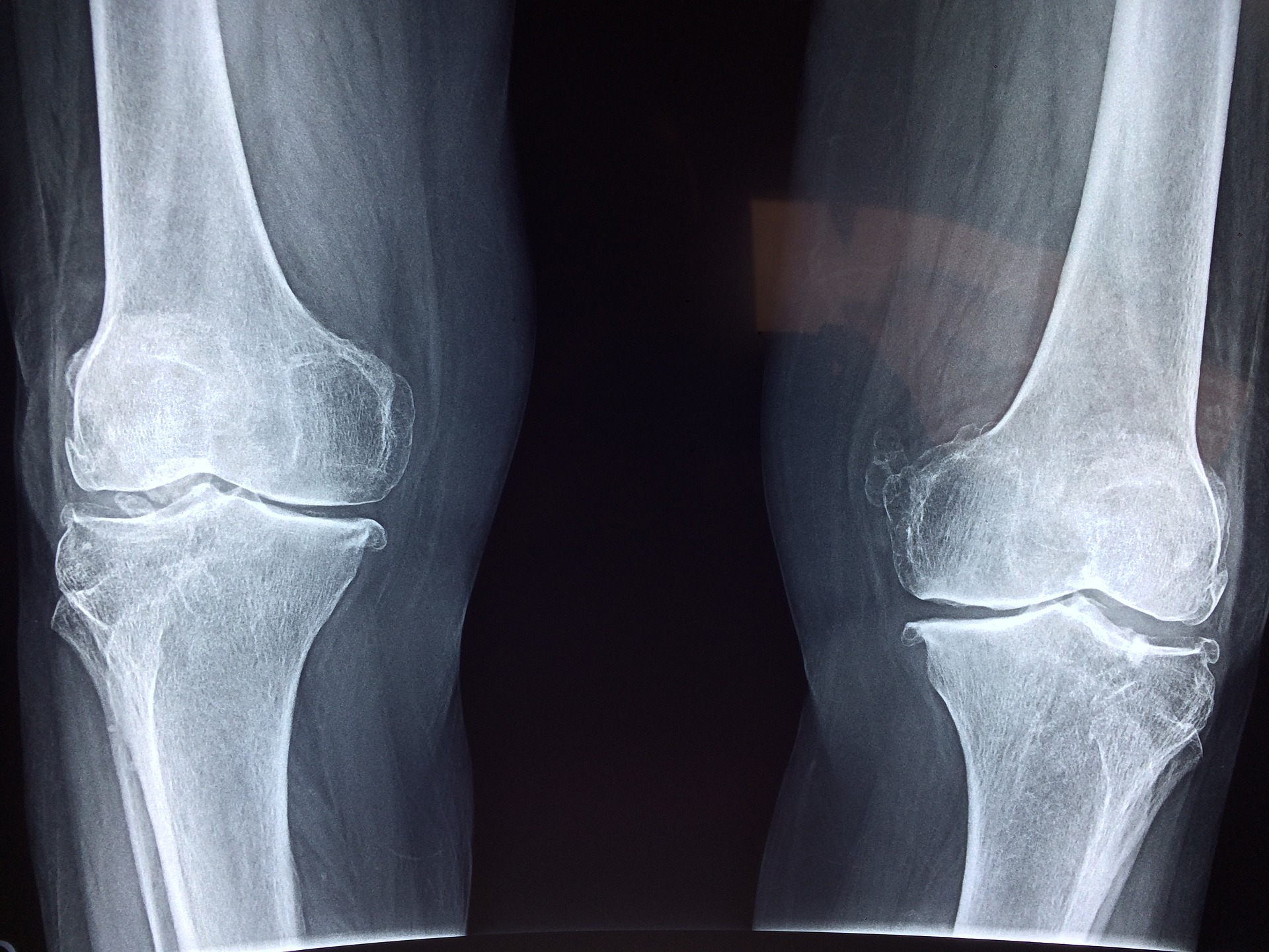 Estos son los síntomas del dolor de rodilla al correr.