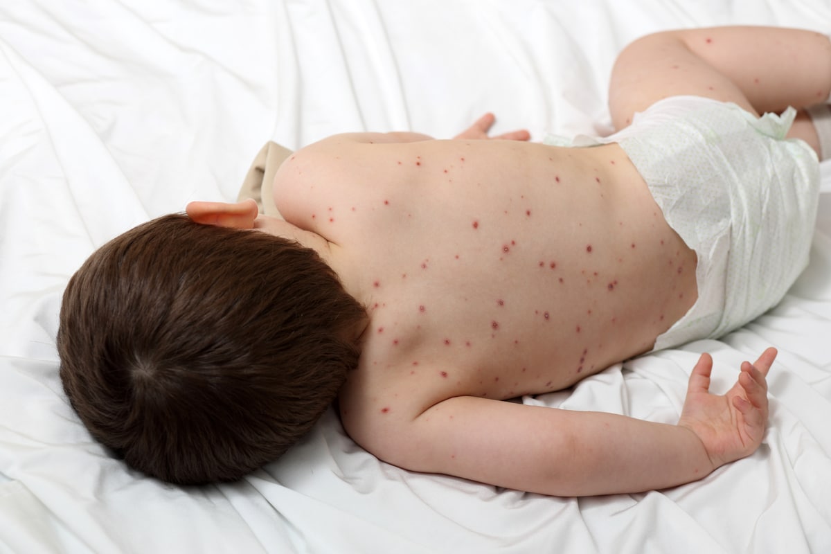 sintomas de la varicela