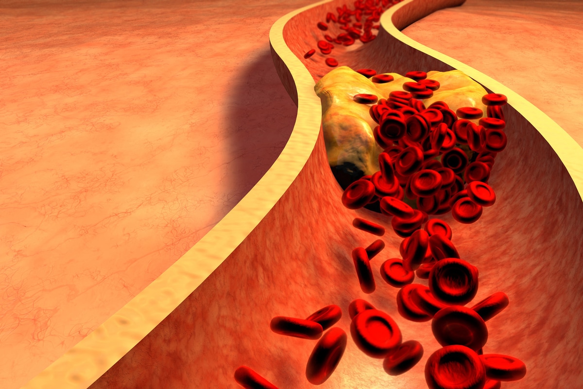 Colesterol alto síntomas y signos que pueden pasar desapercibidos
