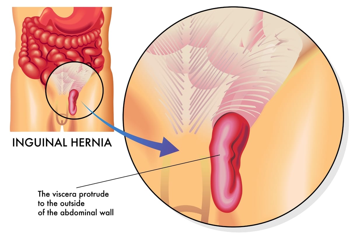 Hernia inguinal sintomas
