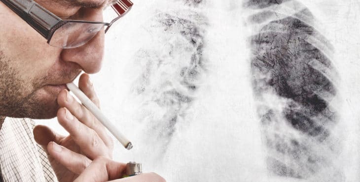 Detección temprana del cáncer de pulmón
