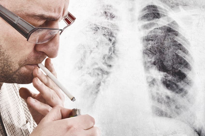 Detección temprana del cáncer de pulmón