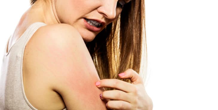 cómo curar la dermatitis