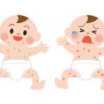 bebé dermatitis
