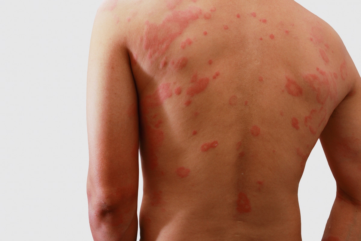 Cómo curar la dermatitis con trucos caseros