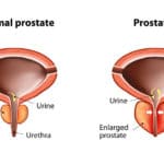 Remedios caseros para una próstata inflamada