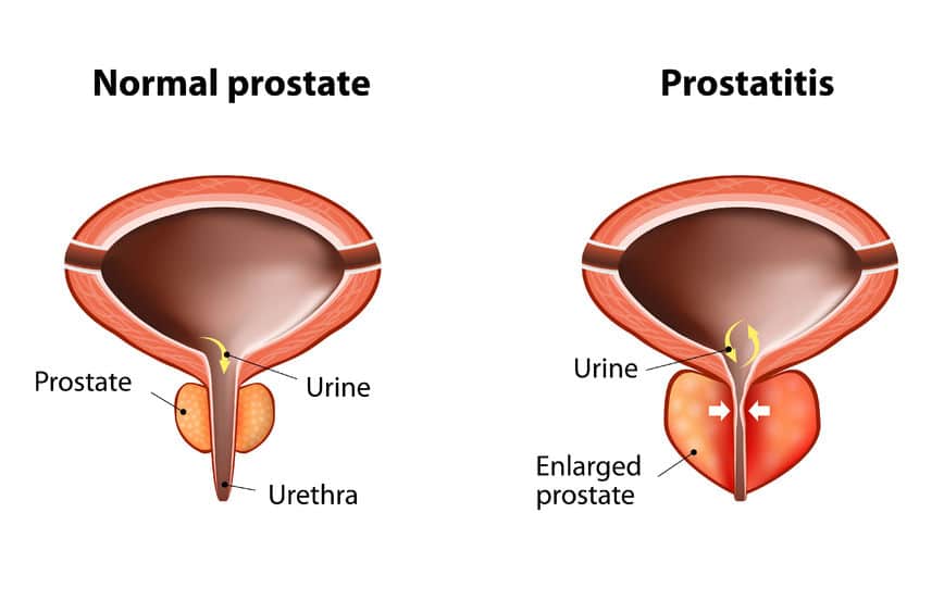 Remedios caseros para la próstata inflamada, ¿qué podemos hacer?