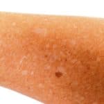 Manchas blancas en la piel asociadas al envejecimiento