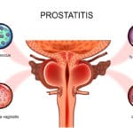 La prostatitis puede ocasionar dolor de testículos