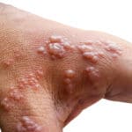 Síntomas del herpes zoster en la mano