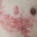 Infección por herpes zóster