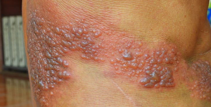 Lesiones del herpes zóster
