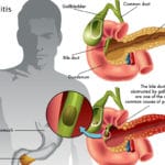 Pancreatitis: un problema en el páncreas