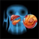 Un serio problema en el páncreas: cáncer
